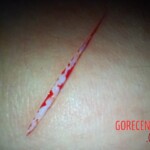 Self-harm on teen girl