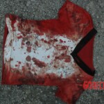 Examination and autopsy of Chinese woman with skull fracture