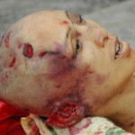 Chinese woman with skull fracture