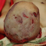Chinese woman with skull fracture