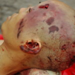 Chinese woman with skull fracture