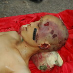 Chinese woman with skull fracture