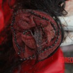 Examination and autopsy of Chinese woman with skull fracture