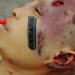 Chinese woman with skull fracture