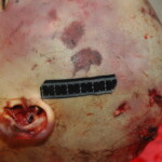 Chinese woman with skull fracture