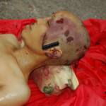 Chinese woman with skull fracture