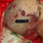 Chinese woman with skull fracture