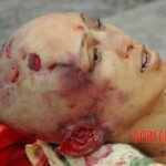 Examination and autopsy of Chinese woman with skull fracture