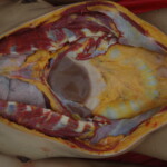 Chinese woman with skull fracture