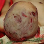 Examination and autopsy of Chinese woman with skull fracture