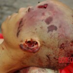 Examination and autopsy of Chinese woman with skull fracture