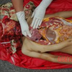 Chinese woman with skull fracture