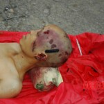 Examination and autopsy of Chinese woman with skull fracture