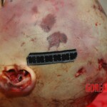 Examination and autopsy of Chinese woman with skull fracture