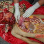 Chinese woman with skull fracture