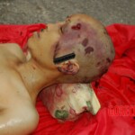 Examination and autopsy of Chinese woman with skull fracture