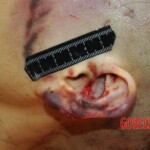 Examination and autopsy of Chinese woman with skull fracture