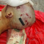 Examination and autopsy of Chinese woman with skull fracture