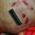 Examination and autopsy of Chinese woman with skull fracture