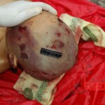 Examination and autopsy of Chinese woman with skull fracture