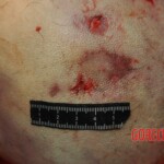Examination and autopsy of Chinese woman with skull fracture