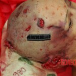 Examination and autopsy of Chinese woman with skull fracture