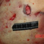 Examination and autopsy of Chinese woman with skull fracture
