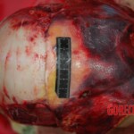 Examination and autopsy of Chinese woman with skull fracture