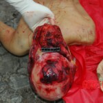 Examination and autopsy of Chinese woman with skull fracture