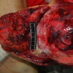 Examination and autopsy of Chinese woman with skull fracture