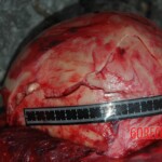 Examination and autopsy of Chinese woman with skull fracture