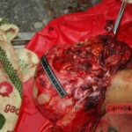 Examination and autopsy of Chinese woman with skull fracture
