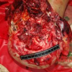 Examination and autopsy of Chinese woman with skull fracture