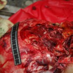 Examination and autopsy of Chinese woman with skull fracture