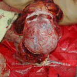 Examination and autopsy of Chinese woman with skull fracture