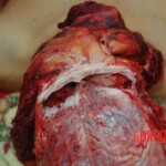 Examination and autopsy of Chinese woman with skull fracture