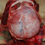 Examination and autopsy of Chinese woman with skull fracture