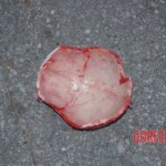 Examination and autopsy of Chinese woman with skull fracture