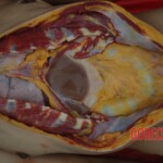 Examination and autopsy of Chinese woman with skull fracture