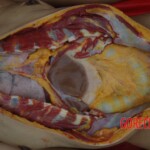 Examination and autopsy of Chinese woman with skull fracture