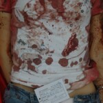 Examination and autopsy of Chinese woman with skull fracture
