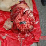 Examination and autopsy of Chinese woman with skull fracture