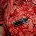 Examination and autopsy of Chinese woman with skull fracture