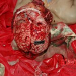 Examination and autopsy of Chinese woman with skull fracture
