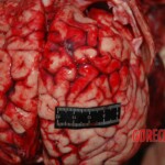Examination and autopsy of Chinese woman with skull fracture