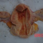 Examination and autopsy of Chinese woman with skull fracture