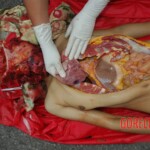 Examination and autopsy of Chinese woman with skull fracture