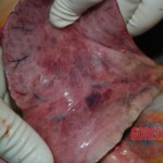 Examination and autopsy of Chinese woman with skull fracture