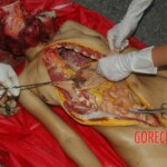 Examination and autopsy of Chinese woman with skull fracture