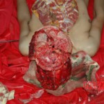 Examination and autopsy of Chinese woman with skull fracture